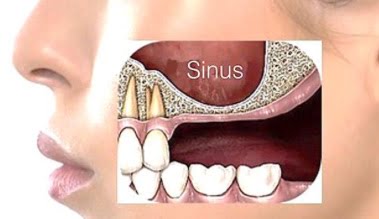 implantes nos dentes do fundo 6 - sinus