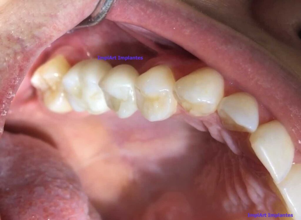 como fica o implante de tres dentes