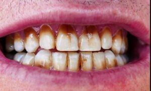 dentes de maconha