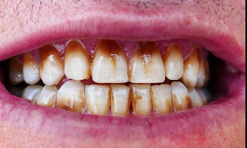 dentes de um usuario de maconha