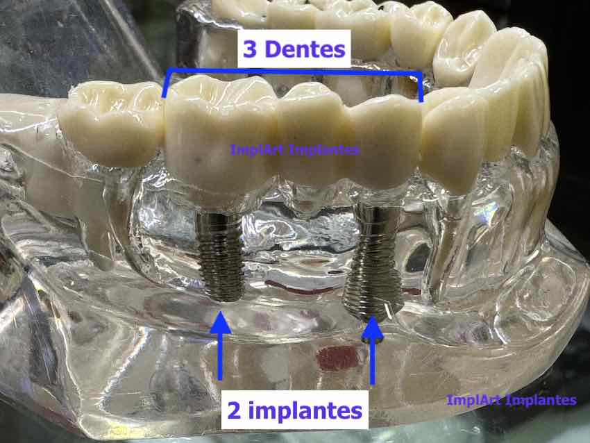 implante de tres dentes com dois implantes