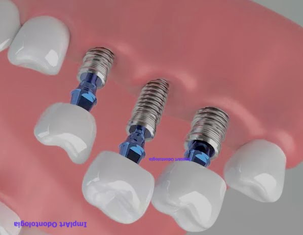 implante de tres dentes juntos