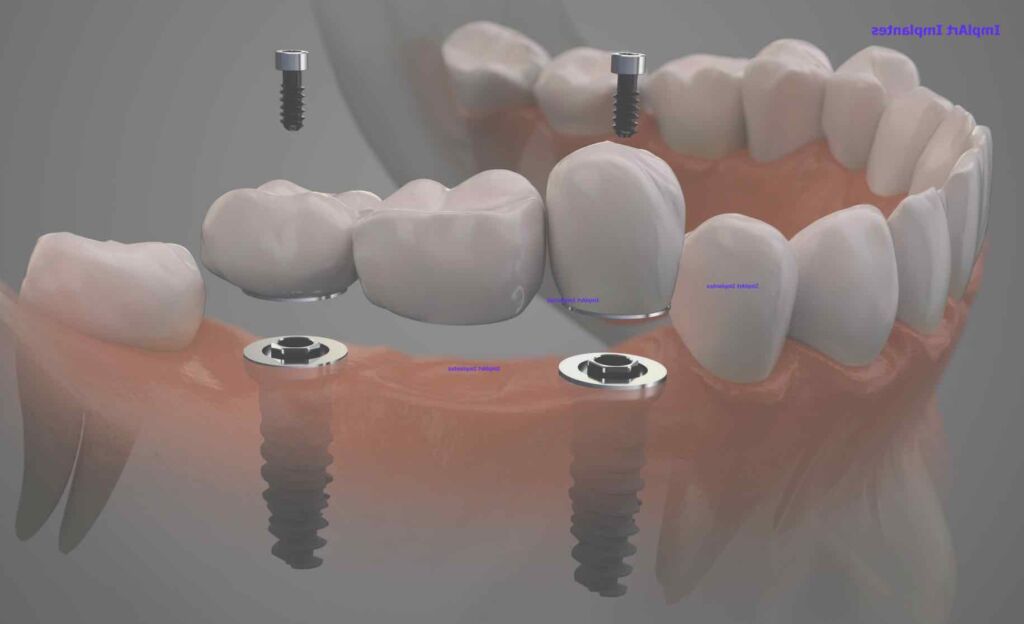 implante de tres dentes - protese fixa