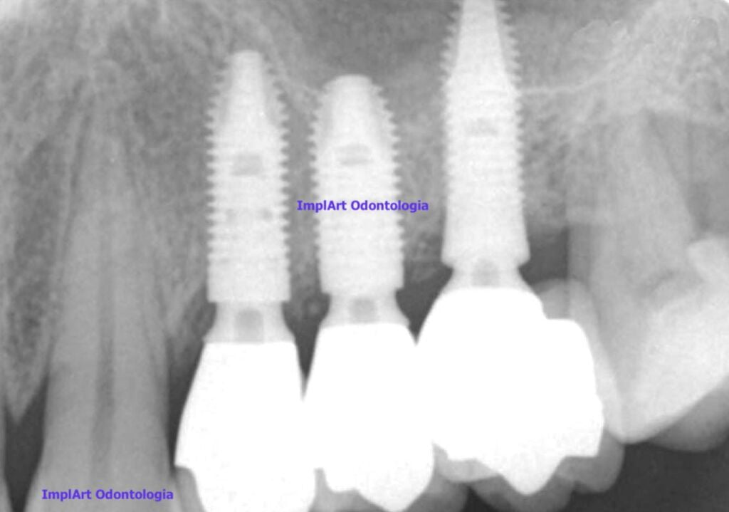 implante de tres dentes radiografia