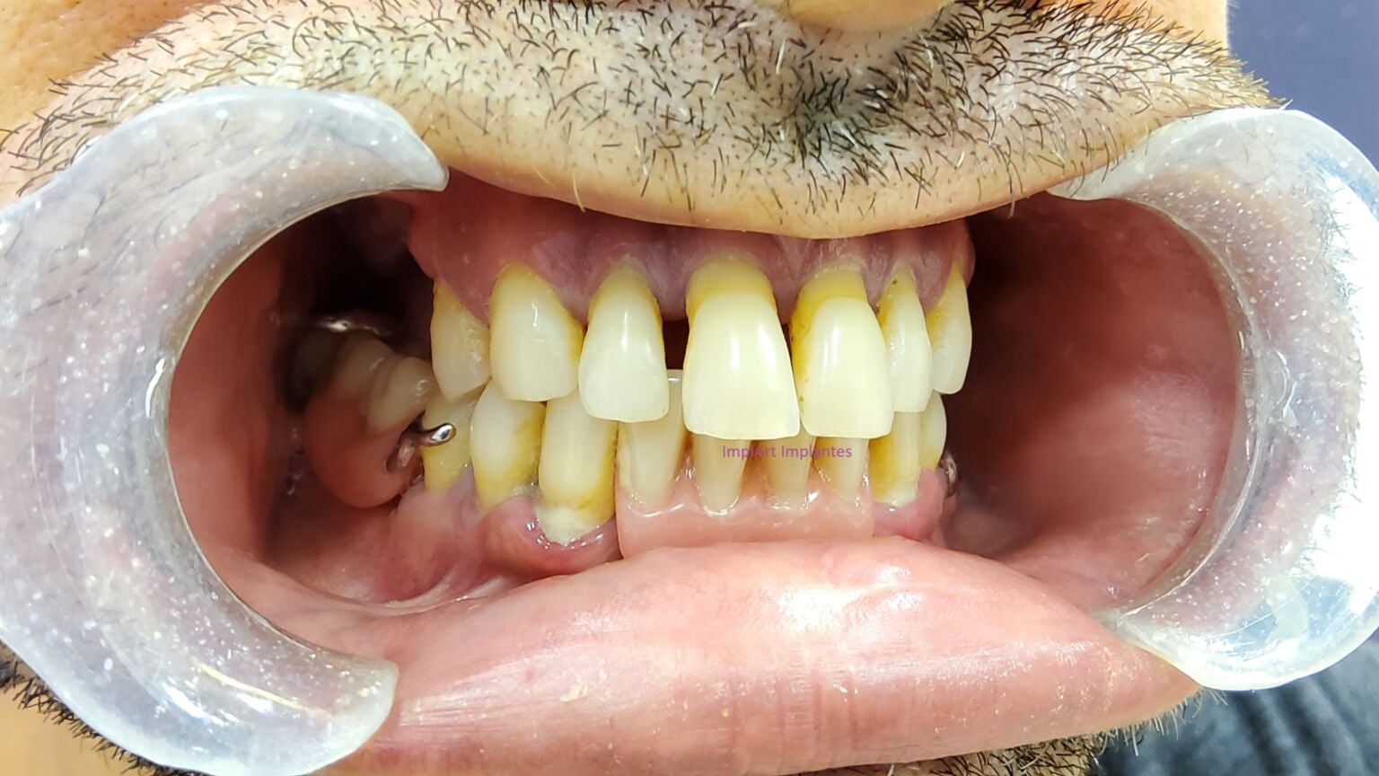 Dente Mole: O que é, Porque Ocorre, Tratamento e Prevenção