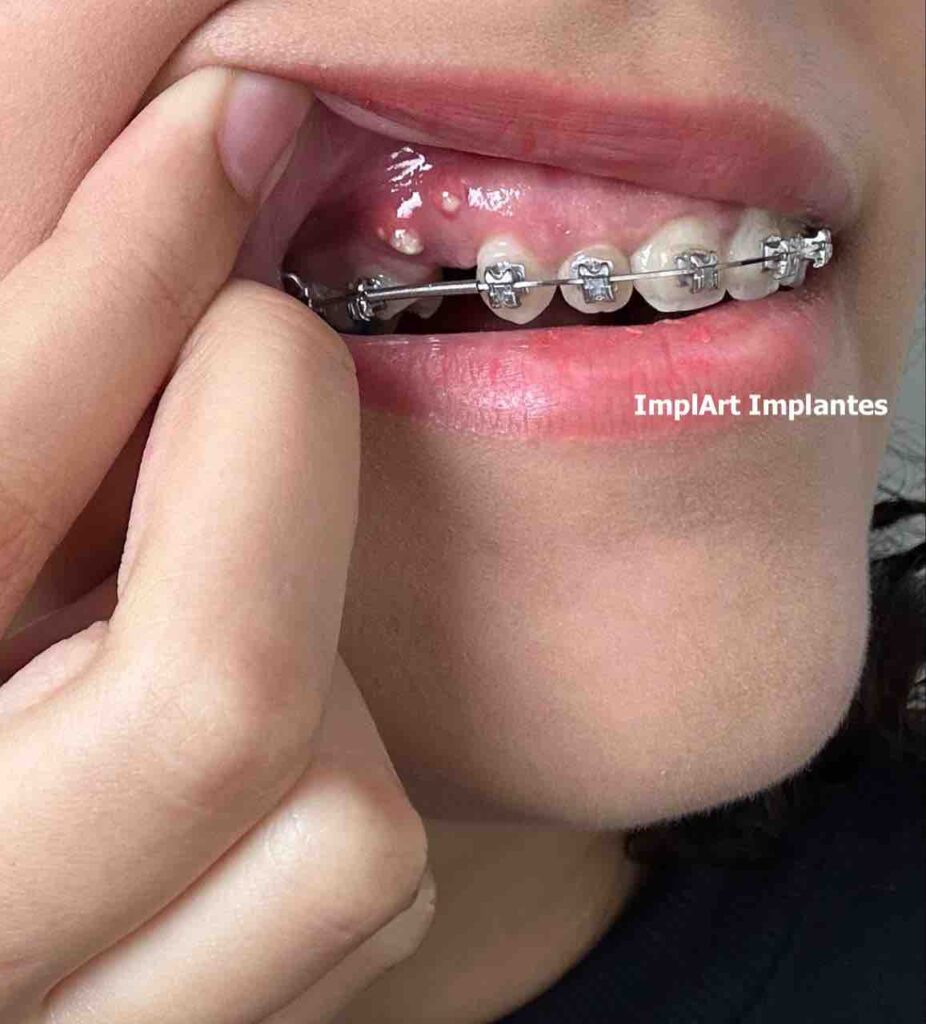manutencao de implantes dentarios