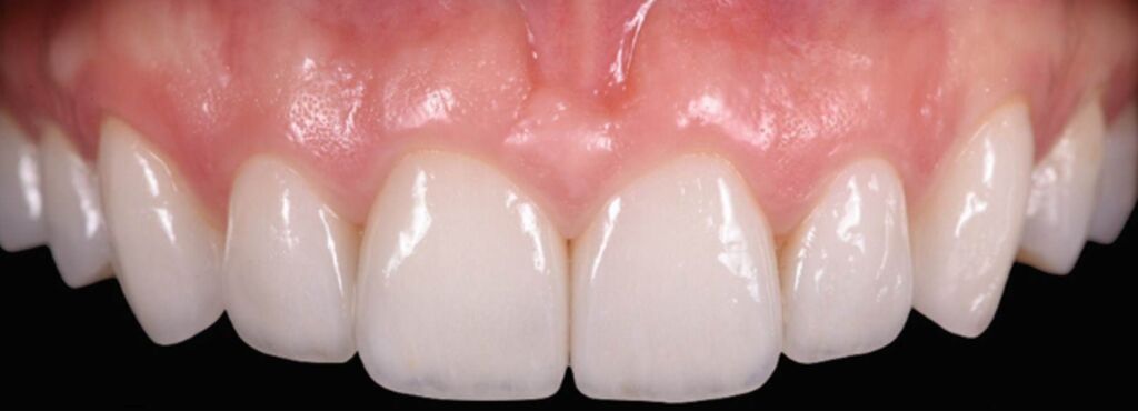 dentes sem perda óssea dentaria saudaveis