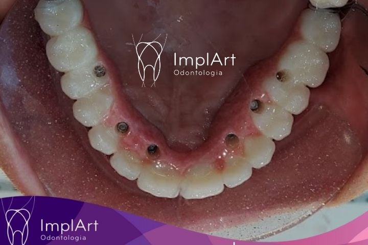 Implantes All on 6: Solução Completa para o Sorriso com implantes 2 protese protocolo implantes all on 6