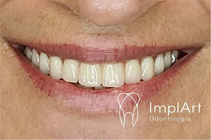RESINA-SITE-010f2999 Prótese protocolo | Gengiva caracterizada e dentes importados