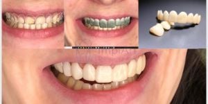 025d7d77 Implante de Três Dentes Juntos - Como fazer ?
