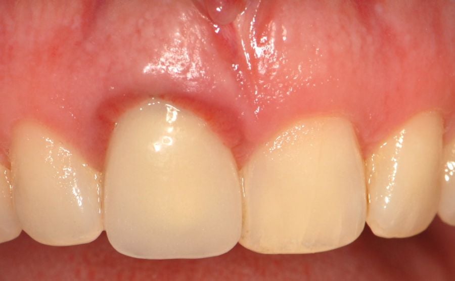 dente_inflamado-022a495b Gengiva inchada: o que pode ser?