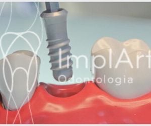 033aaf70 Coroa dentária em um dia para restaurar dentes rápido