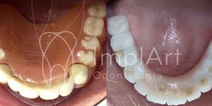 implante_protese_zirconia_total_antes_e_depois_48kb-e1683839971145-03fb64ce As Melhores Clínicas de Implante Dentário em São Paulo