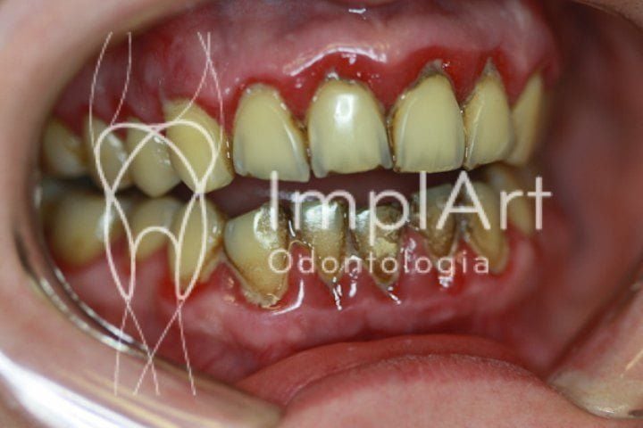 06b3d94a O implante dental e o enxerto ósseo x fumo / cigarro