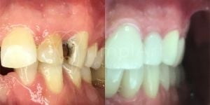 0744ebe8 Implante zigomático: desvantagens e riscos