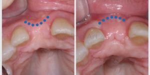 enxerto_osseo_antes_e_depois_41kb-09bb9020 Qual Cor dos Dentes é Ideal para Lentes e Coroas de Porcelana ?