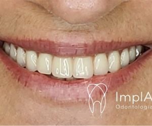 0a7ac408 Enxerto ósseo biomolecular para implante