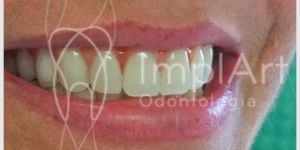 0a92930d 5 problemas graves causados pelas ausências dentárias