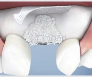 0b6d9a92 Especialista em implantes dentarios - Implantodontista Dr. Roberto Markarian