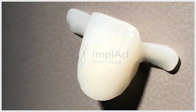 0d878f72 Indicações para a prótese dentaria adesiva