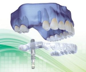 0da8abdf Restaurando Sorrisos com Precisão: Implante Dentário Parcial na Clínica ImplArt