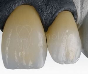 zirconia_cubica_translucida_fx_50kb-0dcd2da8 Novo Implante Straumann iEXCEL: implante rápido com osseointegração em 21 dias