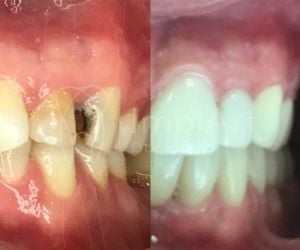 0ec0983f Implantes dentários: alimentação e cuidados após a cirurgia