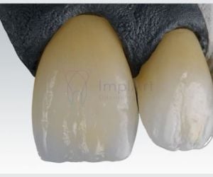 zolid_zirconia_cubica_37kb-0e6afabc Antibióticos na Infância e Riscos Dentários
