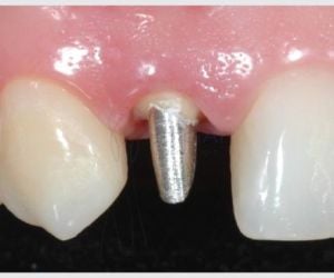 0f437707 Complicações / erros e falhas em implantes dentários