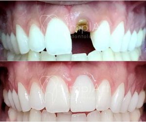 implante_unitario_coroa_metal_free_antes_e_depois_50kb-0fb80bc8 Extração de um dente infeccionado e implante em seguida: é possível?