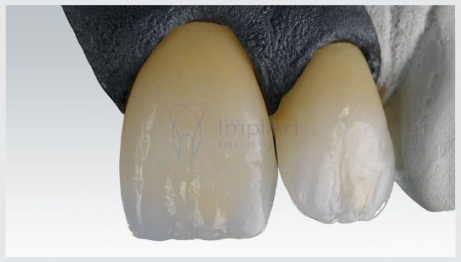 135e7b52 Por que a zircônia é um material resistente?