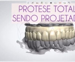 13bad171 Quantos implantes dentários são colocados de cada vez?