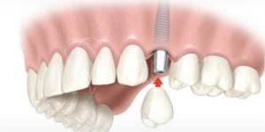 carga_imediata_um_dente_50kb-137d2f33 Cirurgia de implante guiada (fechada) ou cirurgia aberta