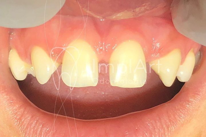 15fa1bef Agenesia dentária e a necessidade de implantes