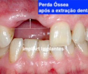 17c1a8f6 Prótese protocolo de resina com estrutura de titânio