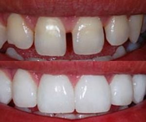 18b5218d Restaurando Sorrisos com Precisão: Implante Dentário Parcial na Clínica ImplArt