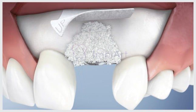 1bee6612 Recuperação de um implante dentário: quanto tempo?