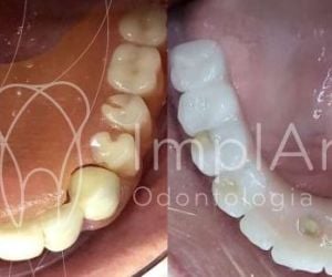 201143b7 Rejeição de implante dentário: pode ocorrer?