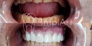 204c795f Perda óssea dentária o que, como evitar, tem tratamento?