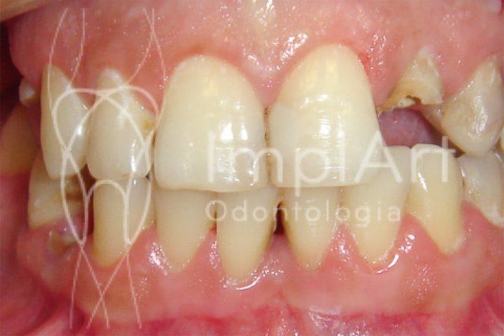 fratura_dental_o_que_fazer_50kb-219aff6d Epilepsia e a Odontologia: tratamento dental e implante dentário