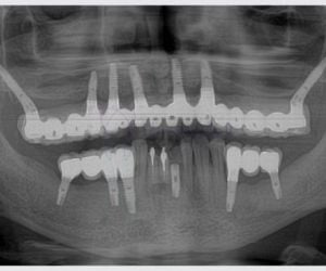 23cb8588 Enxerto ósseo biomolecular para implante