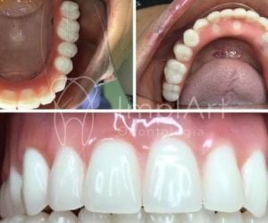 protese_total_resina_fixa_implantes_49kb-231ae946 Sedação odontológica: tratamento dentário para odontofobia