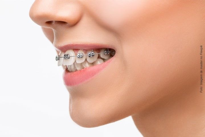 246b00d4 Tratamento mal feito com aparelho ortodôntico pode levar a perda dos dentes