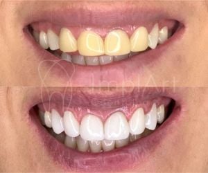 2488a70d Extração de um dente infeccionado e implante em seguida: é possível?