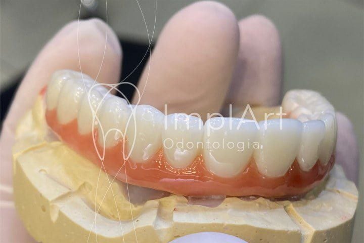 protese_total_zirconia_superior_para_implantes_50kb-2589322f Enxerto ósseo biomolecular para implante