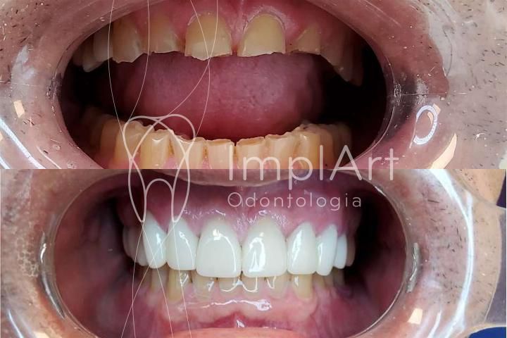 28d1d37e Tratamento de estética dental antes e depois