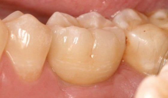 implantes-nos-dentes-do-fundo-4-vista-lateral-280dd5e7 Implantes nos Dentes do fundo:  Conheça os Segredos do sucesso