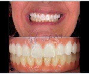 29130573 A Importância da Manutenção de Implantes Dentários