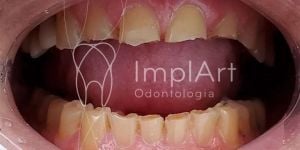 29534aeb Por que é preciso colocar um núcleo para fazer coroas após canal?