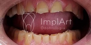 bruxismo_dentes_desgastados-29534aeb Qual Cor dos Dentes é Ideal para Lentes e Coroas de Porcelana ?